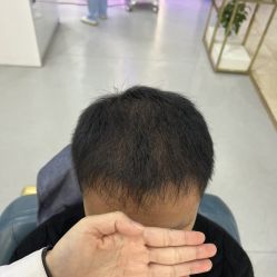 -大麦微针植发全国连锁