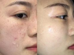 -美安心医美·美迪迈黄金微针·美拉美医疗美容