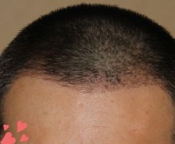 -大麦微针植发丨全国连锁