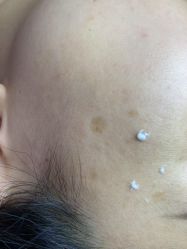 体验后-爱莎扁平疣·汗管瘤·斑痣中心