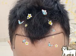 -大麦微针植发全国连锁