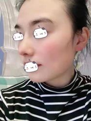 体验后-成都西区医院整形美容