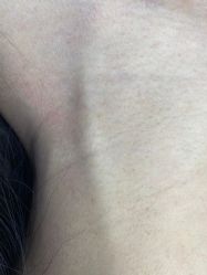 -爱莎扁平疣·汗管瘤·斑痣中心