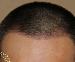 -大麦微针植发丨全国连锁