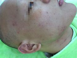 -苗医生草本科技祛痘