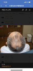 点击看大图 体验前-大麦微针植发全国连锁