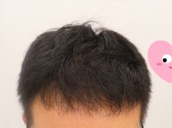 -大麦微针植发全国连锁