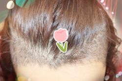 -大麦微针植发全国连锁