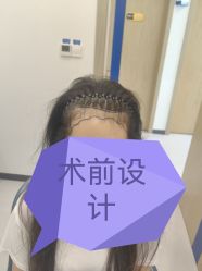 -大麦微针植发全国连锁