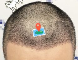 -大麦微针植发全国连锁