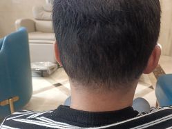 -碧莲盛·不剃发植发