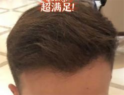 -大麦微针植发全国连锁