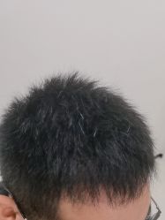 体验后-雍禾植发全国连锁