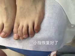 -德哥灰指甲脚气甲沟炎跖疣护理