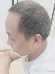 -大麦微针植发丨全国连锁