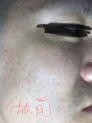 -爱莎扁平疣·汗管瘤·斑痣中心