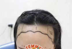 -大麦微针植发全国连锁