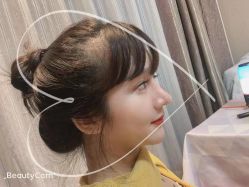 -大麦微针植发丨全国连锁