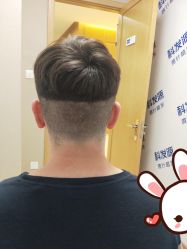 点击看大图 -大麦微针植发丨全国连锁