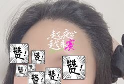 -大麦微针植发全国连锁