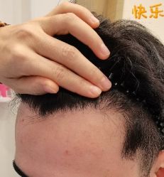 -大麦微针植发丨全国连锁