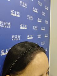 -碧莲盛·不剃发植发