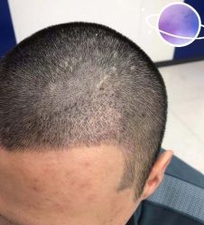 -大麦微针植发丨全国连锁