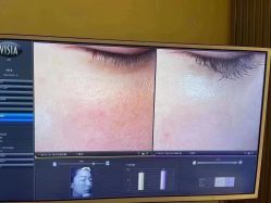 体验后-苑苑vbeauty科技美容SPA