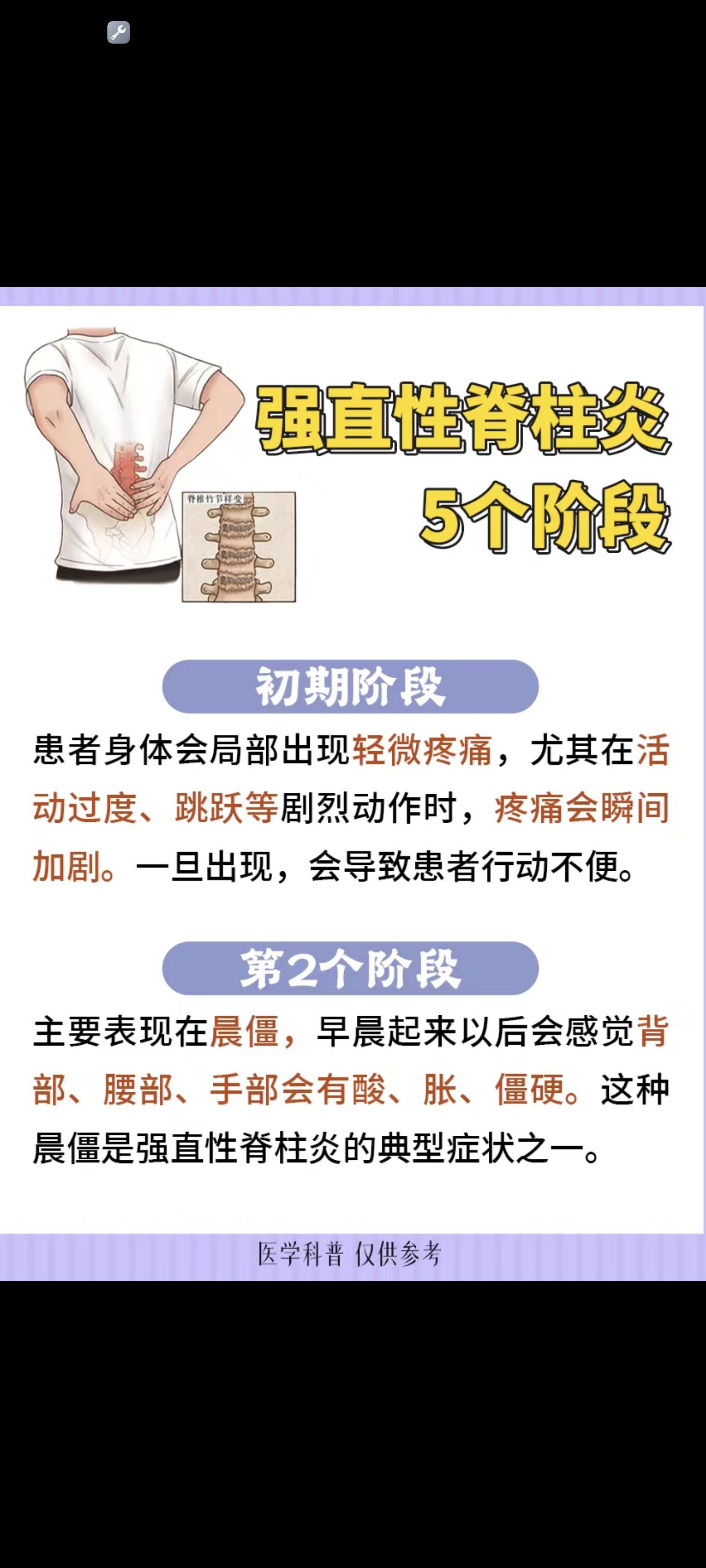 知识科普:强直性脊柱炎