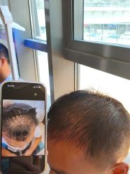 -碧莲盛·不剃发植发