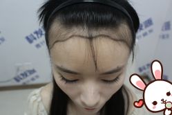 点击看大图 -大麦微针植发丨全国连锁