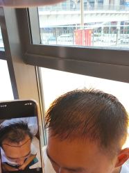 -碧莲盛·不剃发植发