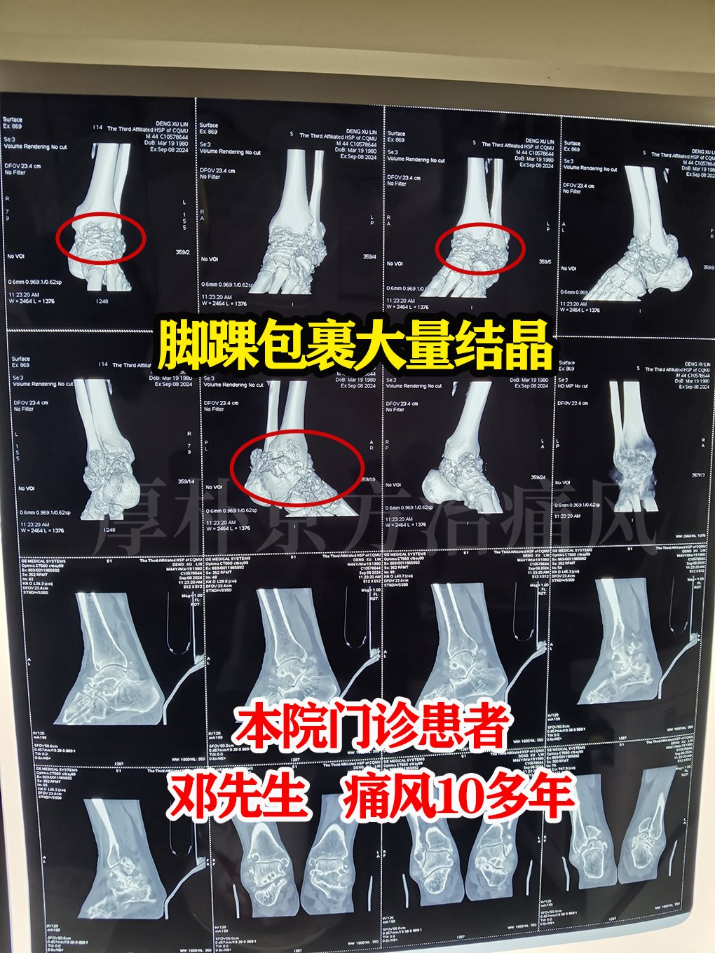 痛风结晶图片x光片图片