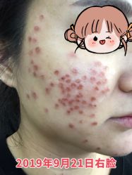 -美丽人生祛斑扁平疣汗管瘤中心
