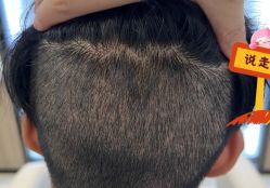 -大麦微针植发全国连锁