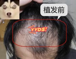 -大麦微针植发全国连锁