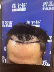 -碧莲盛·不剃发植发