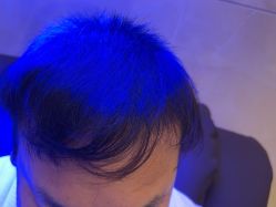 -碧莲盛·不剃发植发