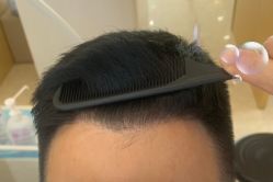 -大麦微针植发丨全国连锁