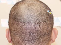 -大麦微针植发全国连锁