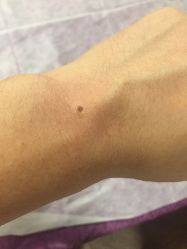 -痣清宫祛斑祛痣连锁店