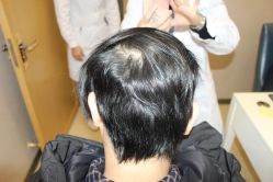 -大麦微针植发丨全国连锁