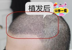 -大麦微针植发全国连锁