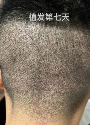 -碧莲盛·不剃发植发