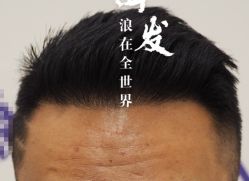 -大麦微针植发全国连锁