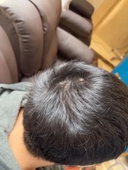 -碧莲盛·不剃发植发