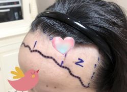 -大麦微针植发全国连锁