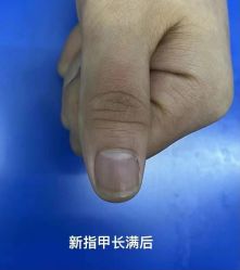 -德哥灰指甲脚气甲沟炎跖疣护理