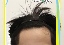 -大麦微针植发全国连锁