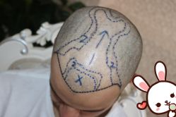 -大麦微针植发丨全国连锁